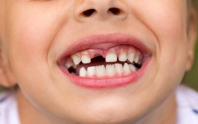 Kid mouth with missing tooth