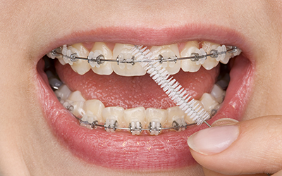 Oral hygiene for braces