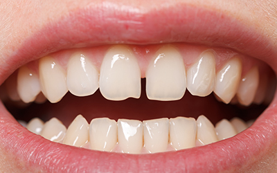 Diastema on Upper Incisors